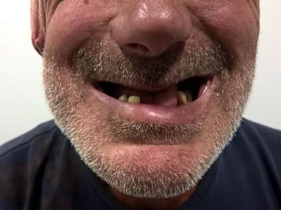 The victim lost five teeth in the attack