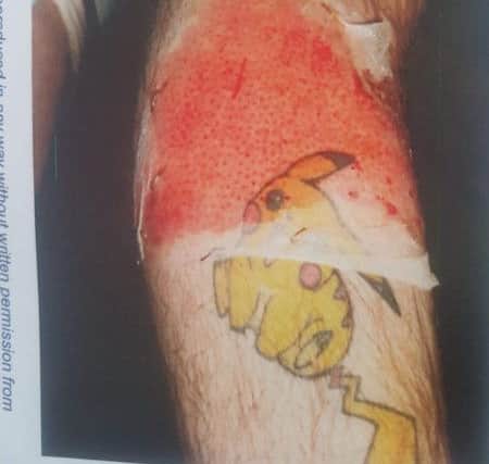 Chris McCormack's leg pictured after the chemical spill.