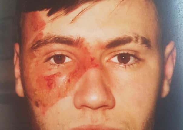 Chris McCormack face was damaged by the hot water and chemical spill.