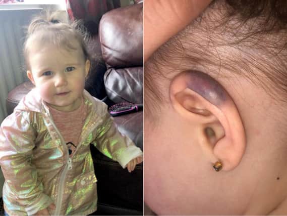 The bruise caused to Freya's ear. Pictures: Mercury Press.