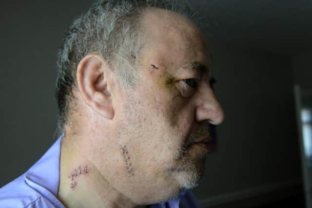 The injuries suffered by Terry Robinson in an attack by Dean Marshall.