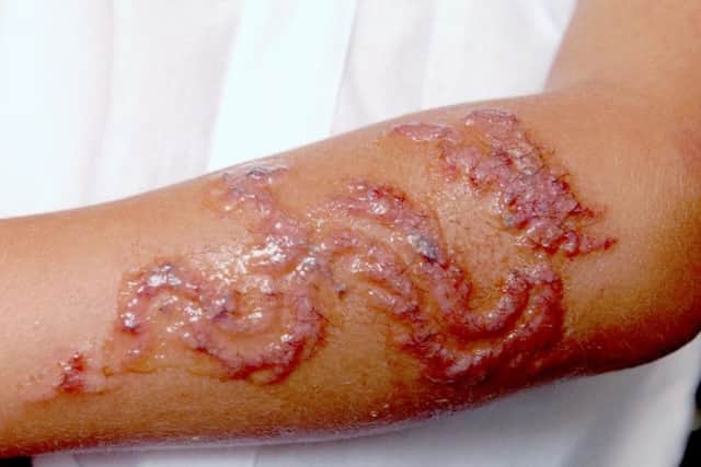 So-called 'black henna' temporary tattoos can cause blistering, burns and permanent scarring.