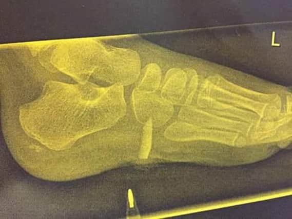 The x-ray which shows the glass in Ruby's foot