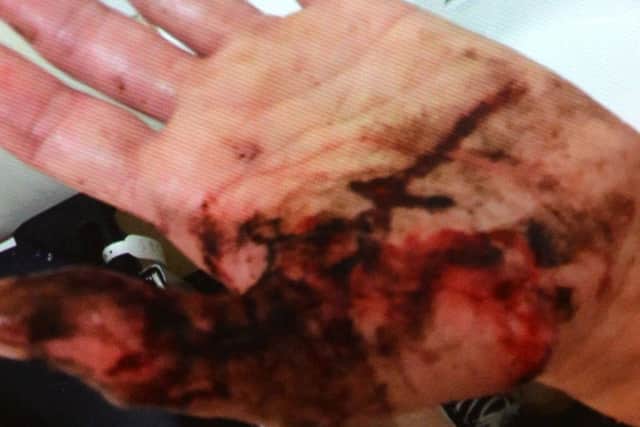 Janice Graney's hand after a husky attacked her dog Alfie.